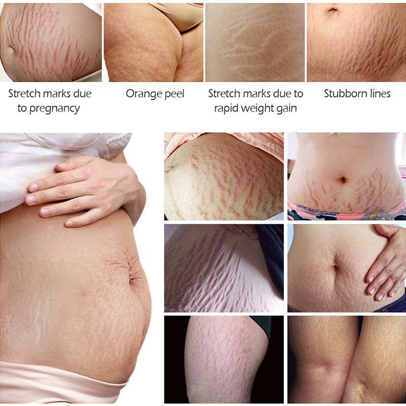 Stretch Mark Essential Oil for Skin Care