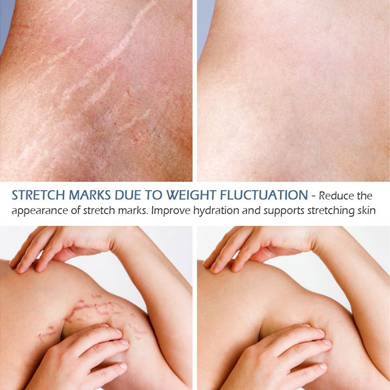 Stretch Mark Essential Oil for Skin Care