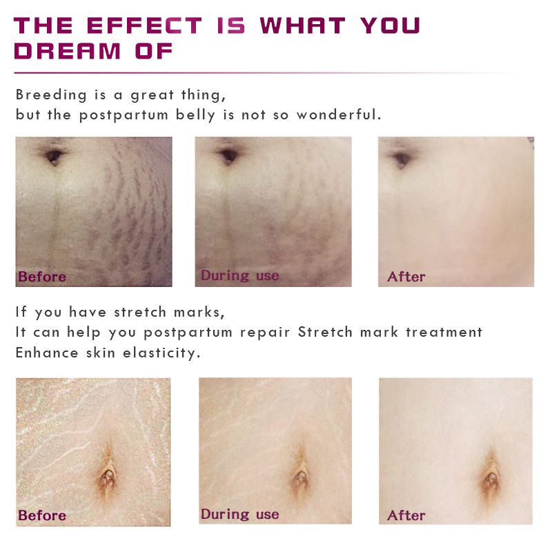 Stretch Mark Essential Oil for Skin Care